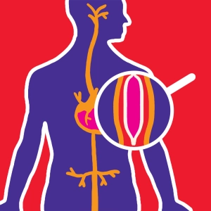 Video: Angioplastia